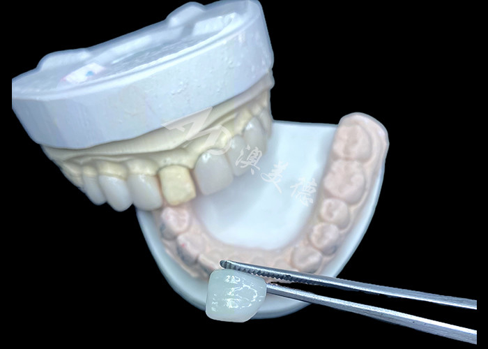 IPS e.max Furniere in BL2-Schatten erzielen eine atemberaubende natürliche Ästhetik mit 8 perfekt gefertigten Einheiten