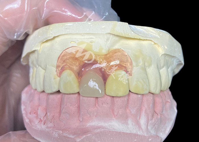 Nesbit flexibler Teilprothese für Schneidmaschinen, die eine nahtlose lösungsfreie Zahnersatzlösung bietet