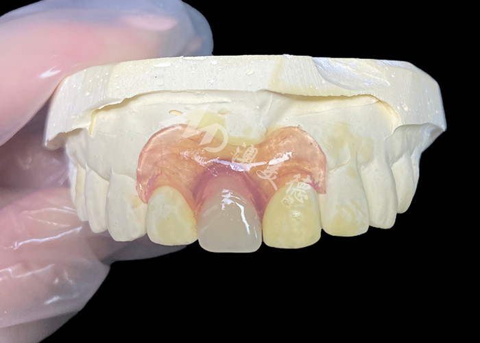 Nesbit flexibler Teilprothese für Schneidmaschinen, die eine nahtlose lösungsfreie Zahnersatzlösung bietet