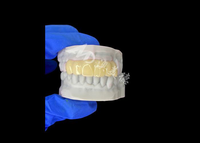 Leichtgewicht Biokompatible 3D-gedruckte Hohlzeitbrücke für Vorimplantat-Restaurationen