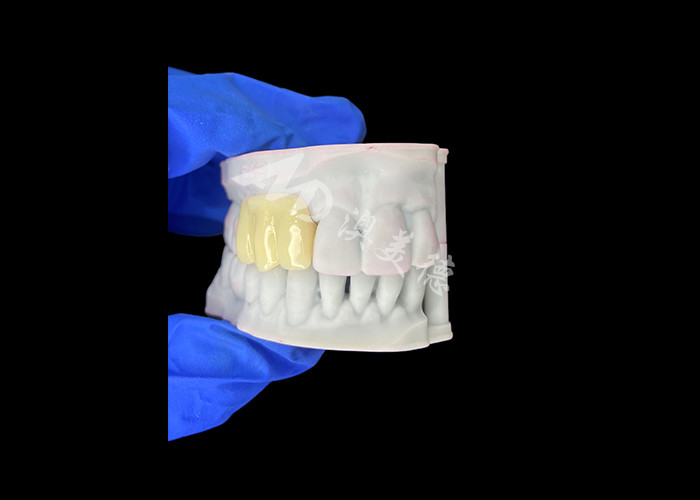 Leichtgewicht Biokompatible 3D-gedruckte Hohlzeitbrücke für Vorimplantat-Restaurationen