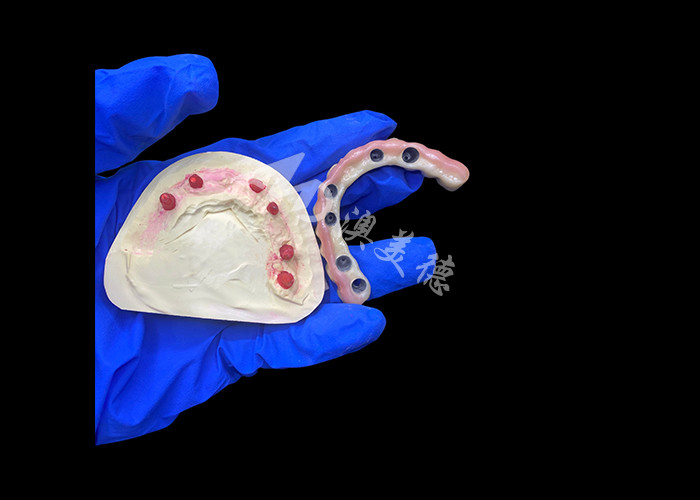 Titanabbutment und Zirkonia-Kronen-Implantat unterstützte Zahnersatz Präzision geeignet für komfortables Tragen
