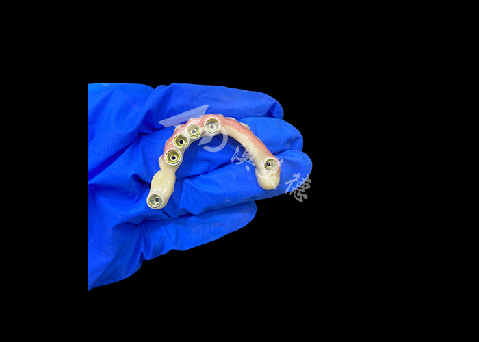 Titanabbutment und Zirkonia-Kronen-Implantat unterstützte Zahnersatz Präzision geeignet für komfortables Tragen