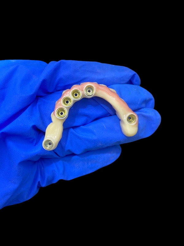 Titanabbutment und Zirkonia-Kronen-Implantat unterstützte Zahnersatz Präzision geeignet für komfortables Tragen