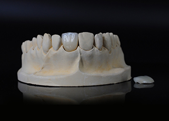 Guter Preis Transluzentes Porzellan Emax Veneer für eine hervorragende Passform / natürliche Ästhetik Online