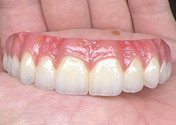 Guter Preis Oral Health Zahnimplantat Unterstützte Zahnprothesen Brücke Polierte Oberfläche Unterstützende vollständige Zahnprothesen Online