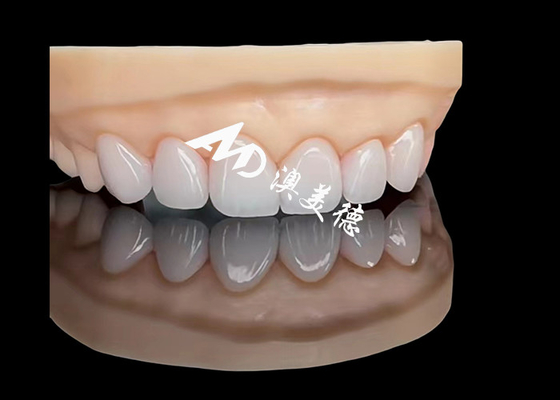 Guter Preis Porzellan EMAX Veneer Hochpräzisions-Ästhetische Restaurationen mit höherer Haltbarkeit Online
