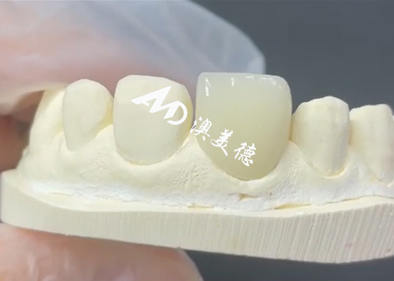 Guter Preis Dauerhafte und ästhetische EMAX-Fenerierung Die perfekte Lösung für Porzellan-Restaurationen Online