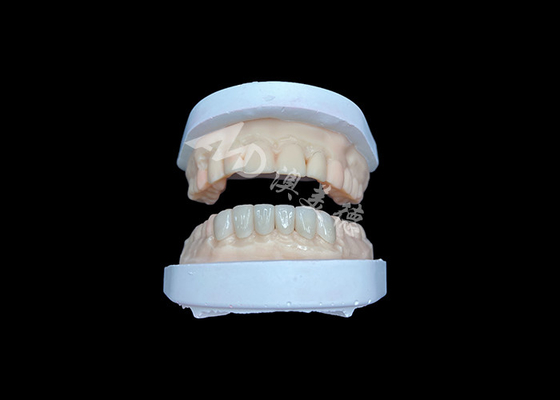 Guter Preis IPS Emax Veneers Natürliche Wiederherstellung für ein ästhetisches Lächeln Online