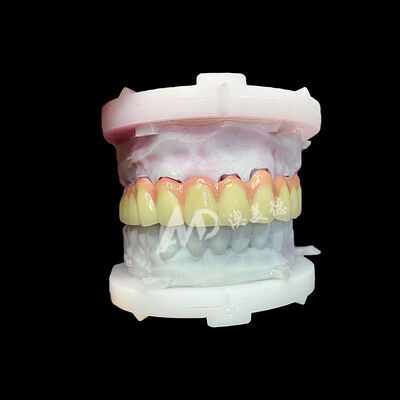 Guter Preis Rein-Titan-Keramik-Krone und -Brücke Langlebig Leichtgewicht Ästhetische Restaurationen Online