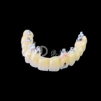 Guter Preis Porzellan-Metall-Verbundene (PFM) Schrauben-Hinterhaltene Implantatbrücke Online